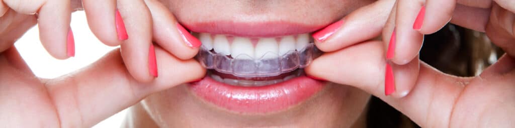 invisalign_banner-1024x255