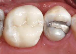 thumb_Single-Posterior-Partial-Coverage_Case-1_After_1024-300x214-1