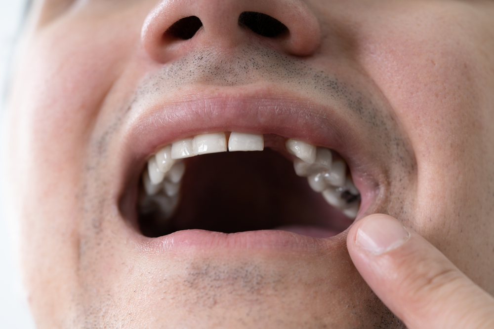 Close up of a man missing a tooth, in need of a dental implant to replace it.
