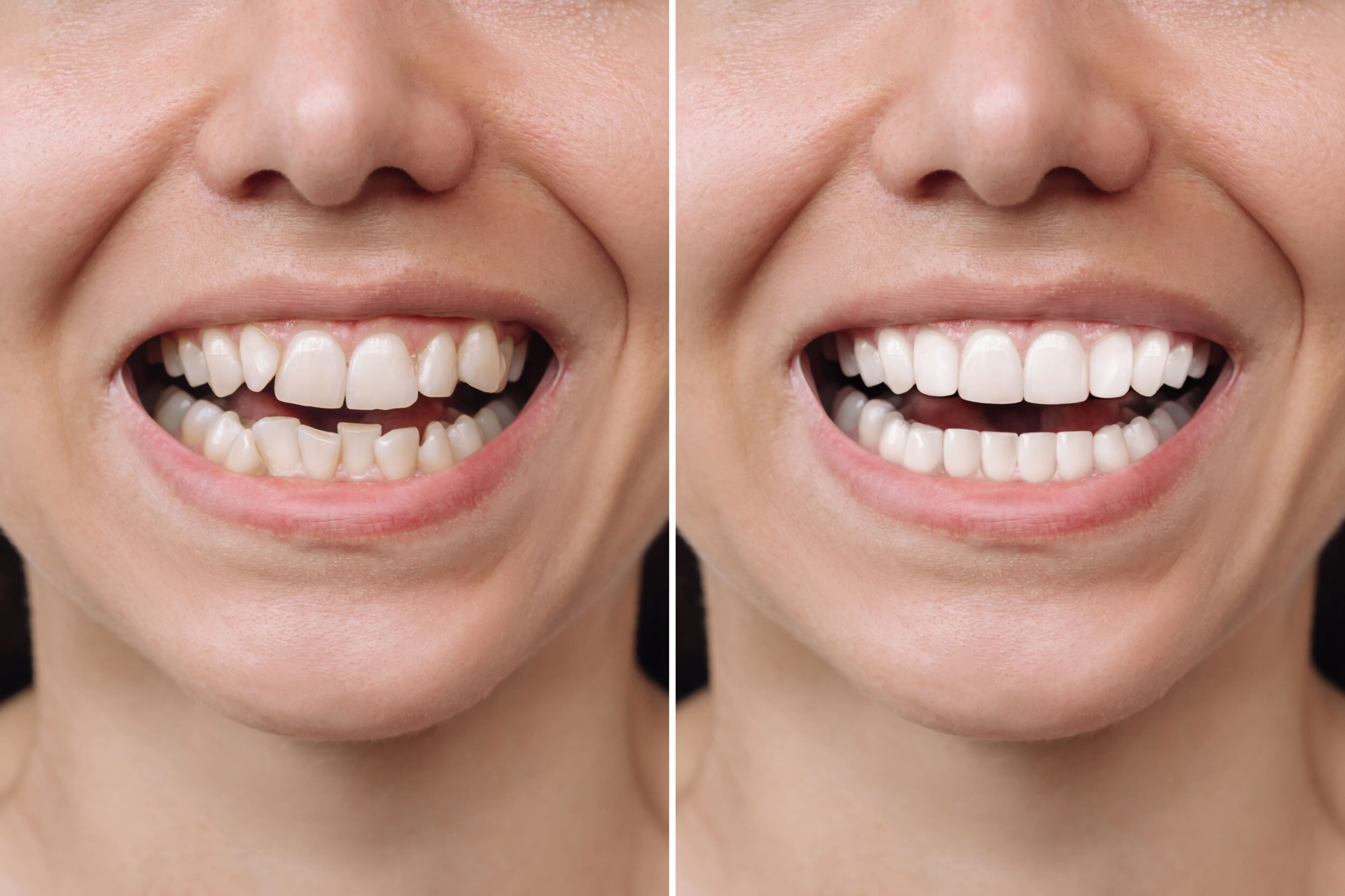 Before and after of a woman who has received veneer treatment to restore the look and functionality of her teeth.